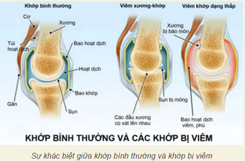  Đau nhức xương khớp ở người trẻ có thể cảnh báo nhiều vấn đề sức khỏe