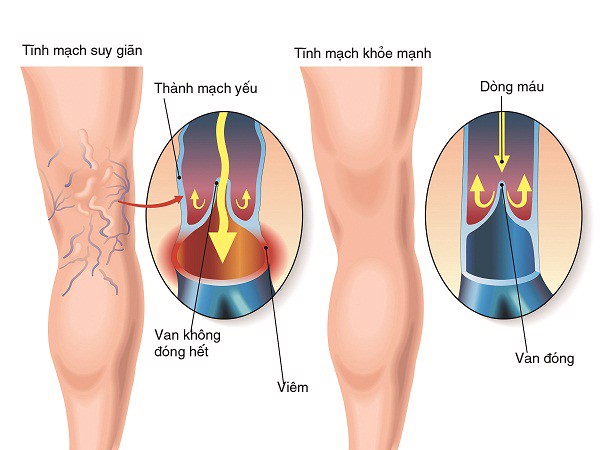  Những điều bạn cần biết về căn bệnh giãn tĩnh mạch nguy hiểm